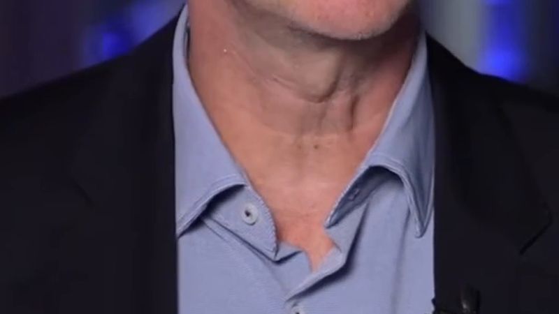 Belçika'da beyin tümöründe umut: iki hastada 5 yıldır hastalık belirtisi yok