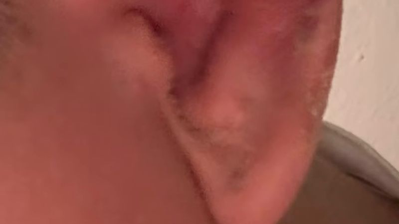 Bursa'da piercing sonrası kulağı iltihaplanan 17 yaşındaki genç 5 gecedir hastanede